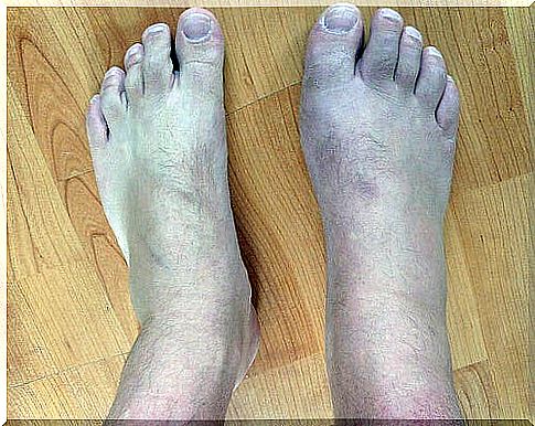 Gout causes swelling of the feet.