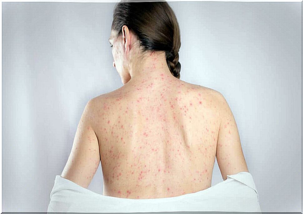 Top 5 Natural Remedies For Herpes Symptoms In The Back