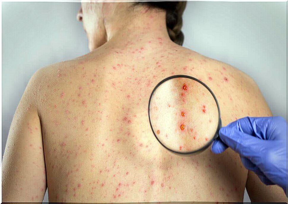 Close symptoms of herpes in the back