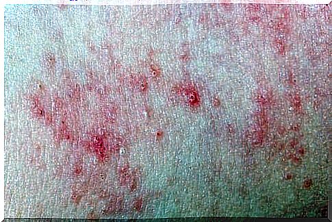 skin diseases and rashes