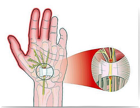 5 Ways to Relieve Pain Caused by Carpal Tunnel Syndrome