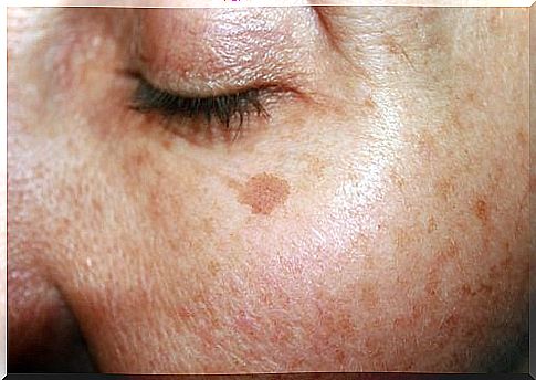 liver spots on the face