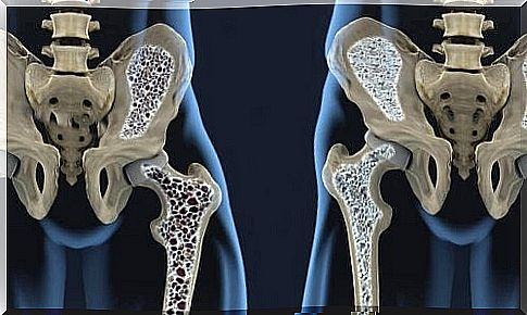 6 diet tips to help prevent osteoporosis