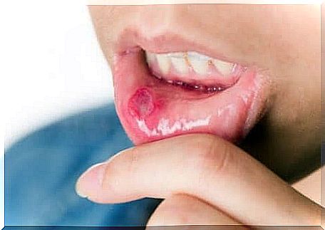 You should not drink tomato juice if you suffer from mouth ulcers