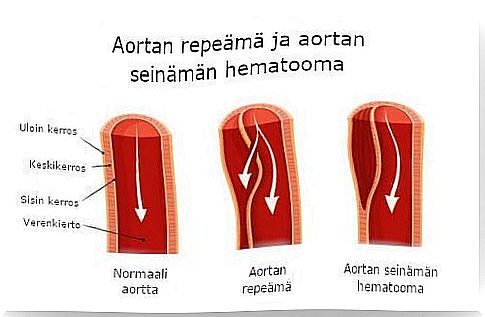 aortic rupture and hematoma