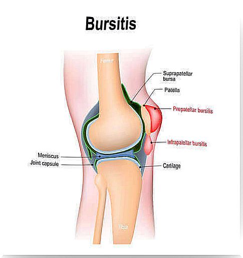 bursitis