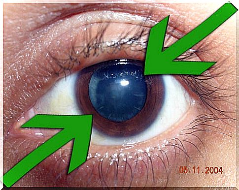 Prevention and treatment of cataracts by natural means