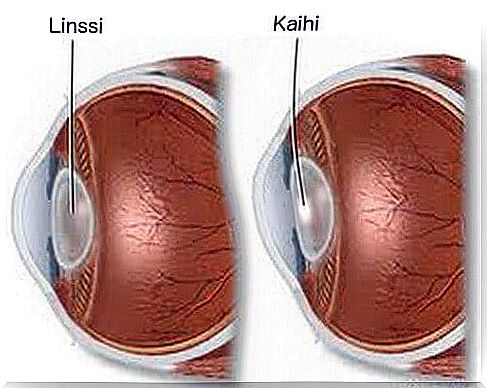 Cataract in the eye