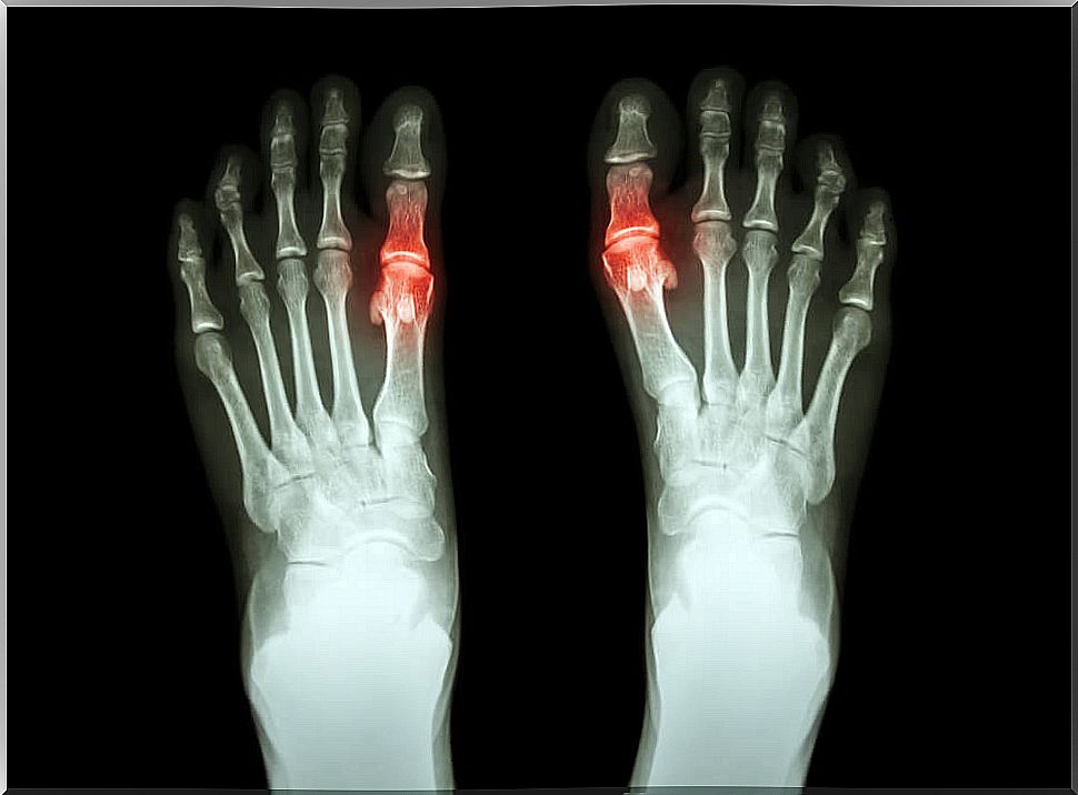 Effective natural treatments for gout