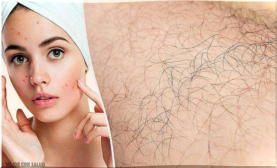 Hirsutism: Causes and Treatment