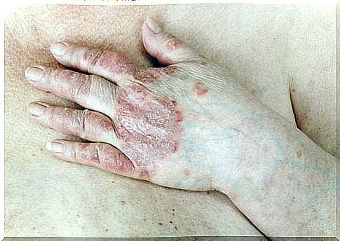 Home constitution for the treatment of psoriasis