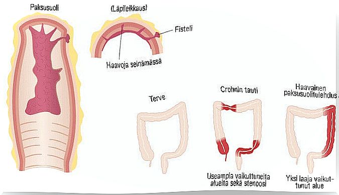 Crohn's disease vs. ulcerative colitis