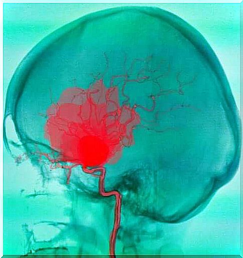 Peritoneal and subcutaneous hemorrhage