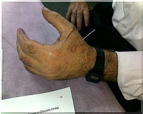 Acupuncture of the hand