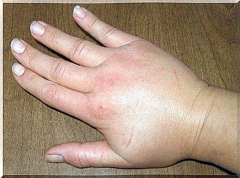 prevent swelling of the hands