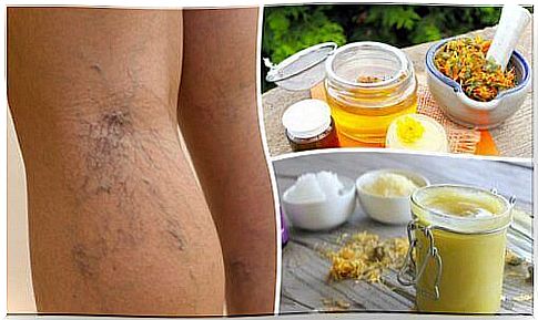 Treat varicose veins with arnica