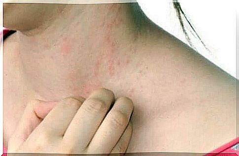 Treatment of urticaria naturally