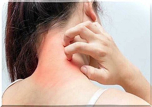 Urticaria causes itchy bangs