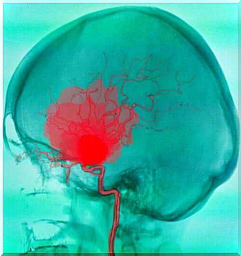 CP injury begins in the brain.