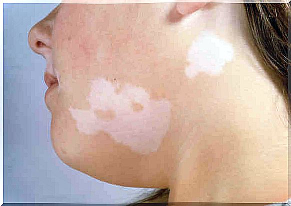 white patches on the skin: vitiligo