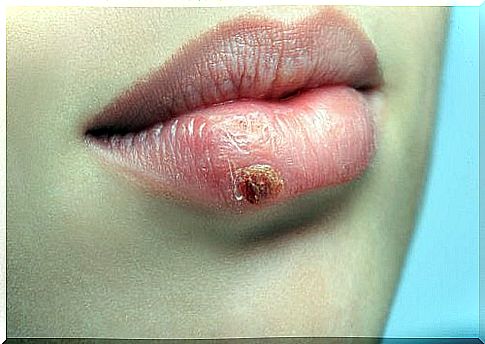 Why does cold sores come back again and again?